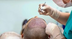 How Do Hair Transplants Work