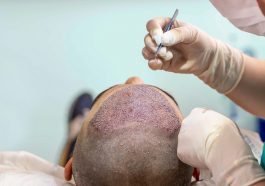 How Do Hair Transplants Work