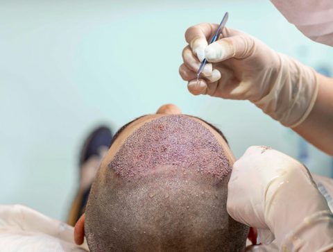 How Do Hair Transplants Work